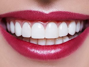Woman showing perfect teeth after cosmetic veneers treatment in her smile.
